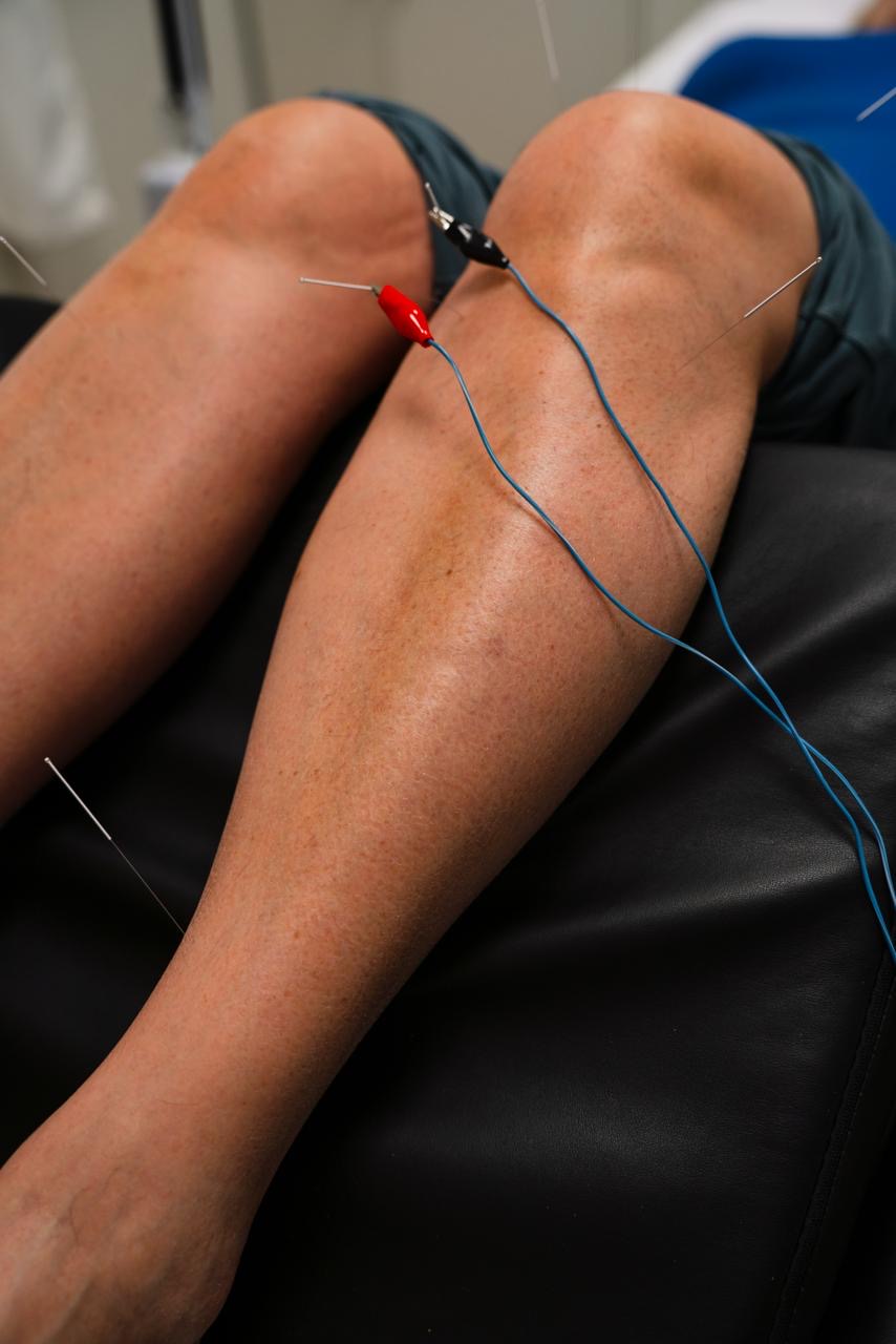 Accupuncture in Edmonton - healing and rejuvenation